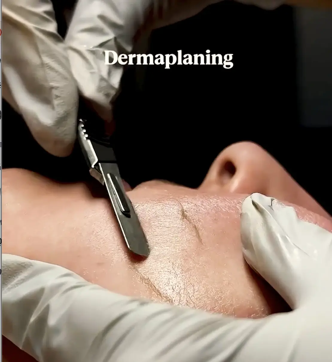 Dermaplaning facial treatment